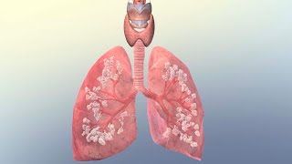 Common Causes of Respiratory Failure [upl. by Trah]