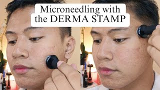 Acne Scar Treatment using Derma Stamp from Banish [upl. by Ardnuasac866]