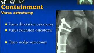 Perthes Disease [upl. by Sivrad]