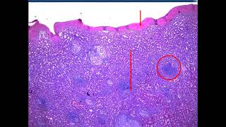 Sarcoidosis Rhino Actinomycosis Leprosy FB 2024  jars and slides [upl. by Meda]