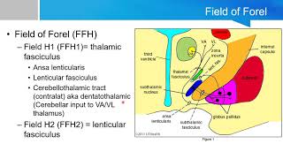 Neurosurgery written board crash course  basal ganglia part 2 [upl. by Oakes]