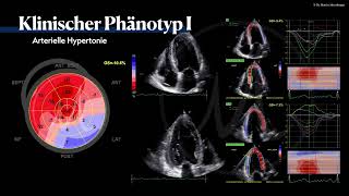 〖Echokardiografie〗 Arterielle Hypertension  HFpEF Phänotyp🫀 [upl. by Rior30]