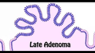 Animated Histology Colon Cancer Progression [upl. by Demmahom]