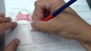 Removable Partial Denture  Reviewing design and how to draw [upl. by Pate]