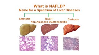 What is NonAlcoholic Fatty Liver Disease NAFLD [upl. by Nanerb]