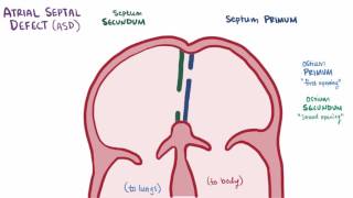 Atrial septal defect ASD repair causes types symptoms amp pathology [upl. by Ovid]