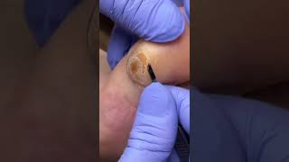 SCRAPING OFF A HUGE TOE CALLUS 🤯 shorts [upl. by Ravi]