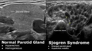 Salivary Glands Ultrasound Normal Vs Abnormal Images  Parotid Submandibular amp Sublingual Gland USG [upl. by Bunch]