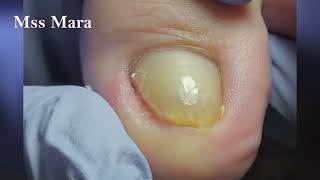 Mss Mara Ep62  Podological procedure Frequent case of onychomycosisl Toenail cleaning [upl. by Kirstyn]