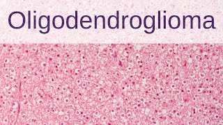 Oligodendroglioma  Pathology mini tutorial [upl. by Devora79]