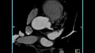 Cardiac extensive calcifications in the LAD 4of 4 [upl. by Anuahsed]