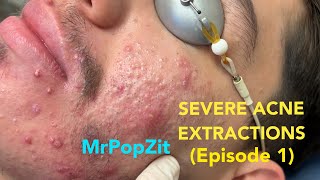 Severe acne extractions episode 1 Comedones and pore dirt removed Part 1 of 3 So many pops [upl. by Osnofledi]