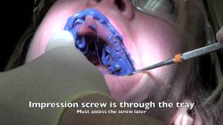 Dental Implant  Impression and Insertion of crown [upl. by Kelsy390]