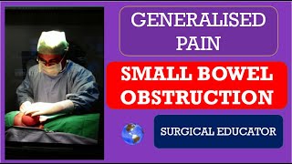 SMALL BOWEL OBSTRUCTION How To DIAGNOSE amp TREAT  GENERALISED ABDOMINAL PAIN [upl. by Robi]