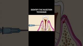 The Supplemental Injection Technique [upl. by Isayg]