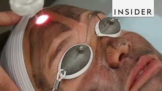 Get Glowing Skin With A Laser Facial [upl. by Carhart959]