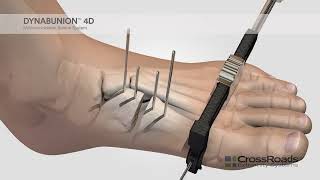 dynaBunion™ 4D MinimalIncision Lapidus System  Surgical Animation [upl. by Zanze]