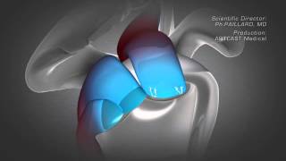 Shoulder Arthroscopy  Rotator Cuff Repair [upl. by Kwei780]