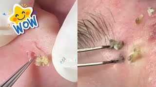 Ultimate Compilation of Most Satisfying Pimple Popping Blackhead Extractions amp Acne Treatment [upl. by Ludmilla]