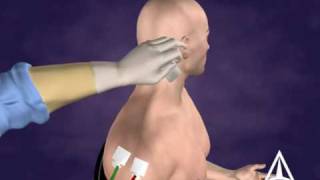 Botulinum Toxin B Injection Technique  3D Medical Animation [upl. by Felipa556]