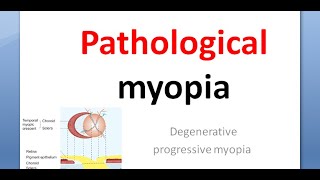 Ophthalmology Pathological myopia crescent Foster Fuchs spot lattice posterior staphyloma atropine [upl. by Tolley839]