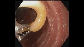 Ascariasis Removal from papilla BDENDOSCOPY [upl. by Golub]