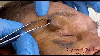 Draining a facial hematoma [upl. by Miranda]