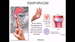 Diaphragm contraceptive [upl. by Tolman501]