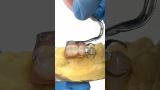 Adding a Crown for a Metal Clasped Partial lsk121shorts dentistry teeth [upl. by Proud]