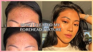 HOW TO REALLY GET RID OF FOREHEAD ACNE  TEXTURE  Christine Le [upl. by Ellirehs392]