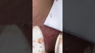 Big Cystic Acne Blackheads Extraction Blackheads amp Milia Whiteheads Removal Pimple Popping shorts [upl. by Ecnaret]