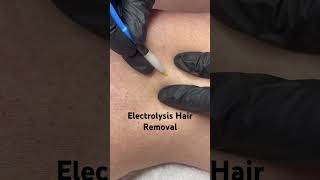 Electrolysis Hair Removal [upl. by Collen814]