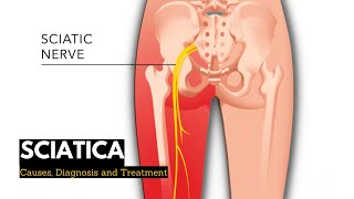 Sciatica  Onesided Leg pain and tingling Sciatica Symptoms and Treatment Radiculopathy [upl. by Ardnuaet]