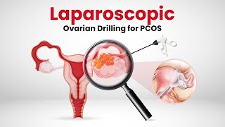 Laparoscopic Ovarian Drilling for PCOS  What is it Can Ovarian Drilling cure PCOS [upl. by Je]