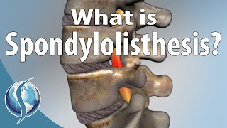 What Is Spondylolisthesis [upl. by Eceerahs]