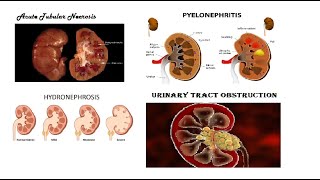 Pathology Urogenital  Tubular Disease amp Pyelonephritis amp Hydronephrosis amp Urinary Tract Obstruction [upl. by Enialehs253]