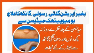 quotGilti aur Rasoli ka Homeopathic Ilaj A Natural Treatmentquot [upl. by Hogg]