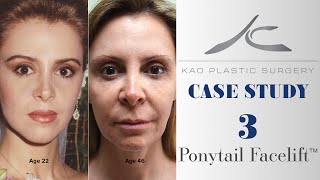 Case Study 3 Zonia Ponytail Facelift™ [upl. by Randal253]