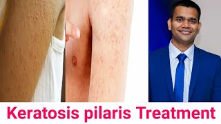 Keratosis Pilaris Cause Symptoms Ayurvedic Treatment [upl. by Kabob]