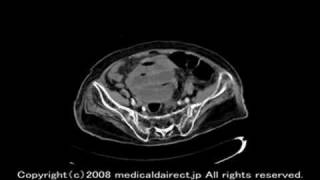 Acute abdomen 急性腹症、高齢者 [upl. by Lomax]