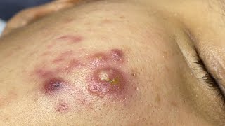 Satisfying With Loan Nguyen Spa Video 064 acnetreatment [upl. by Dore]