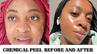 CHEMICAL PEEL FULL PROCESS BEFORE amp AFTER  HYPERPIGMENTATIONACNE ON BLACK SKIN  THE PERFECT PEEL [upl. by Hnahk]