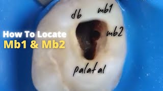 How to locate Mb1 amp Mb2 🟡 maxillary first molar [upl. by Hut]