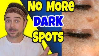 Tips for Dark Spots Hyperpigmentation and Melasma [upl. by Nabatse927]