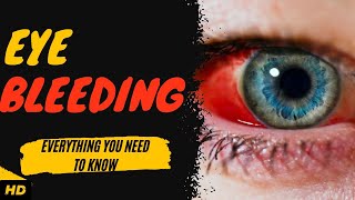 Eye Bleeding Everything You Need To Know [upl. by Augustus]