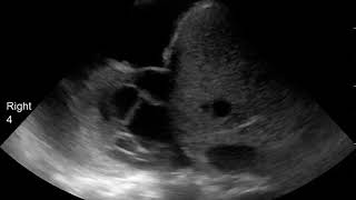 POCUS in COVID19 Rightsided pleural effusion with multiple thick fibrin strands [upl. by Aicetel310]