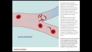 Sikkelcelcrisis  Sikkelcelziekte [upl. by Beichner]