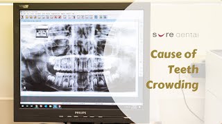 Adult braces timelapse 6 months [upl. by Suravaj9]