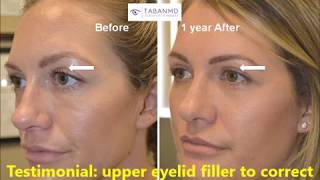 Upper Eyelid Filler injection to correct hollowness after upper blepharoplasty [upl. by Airbmak]