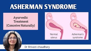 Asherman syndrome  cause symptoms amp ayurvedic treatment in Hindi endometrium ashermansyndrome [upl. by Travax]